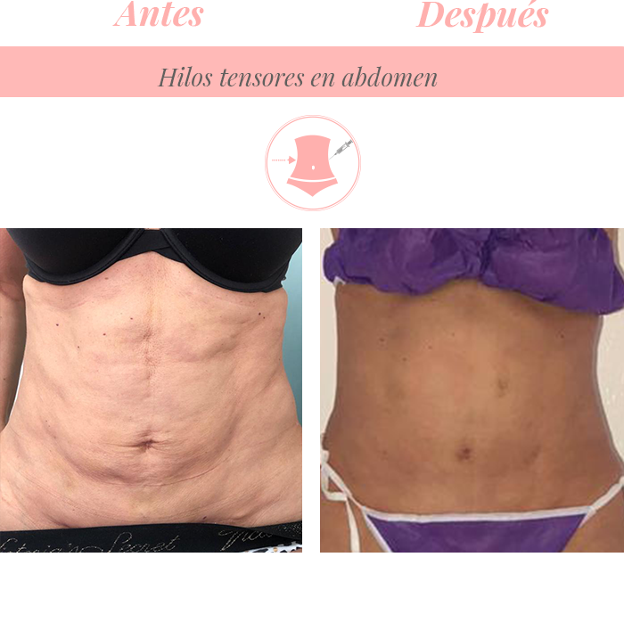Hilos de colágeno en abdomen en Promoestetica - Antes y después