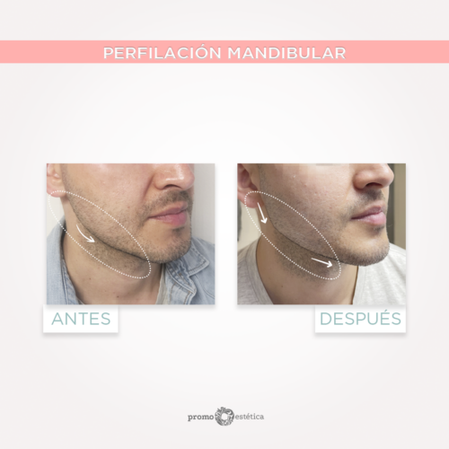 Perfilacion facial en promoestetica - antes y despues 2