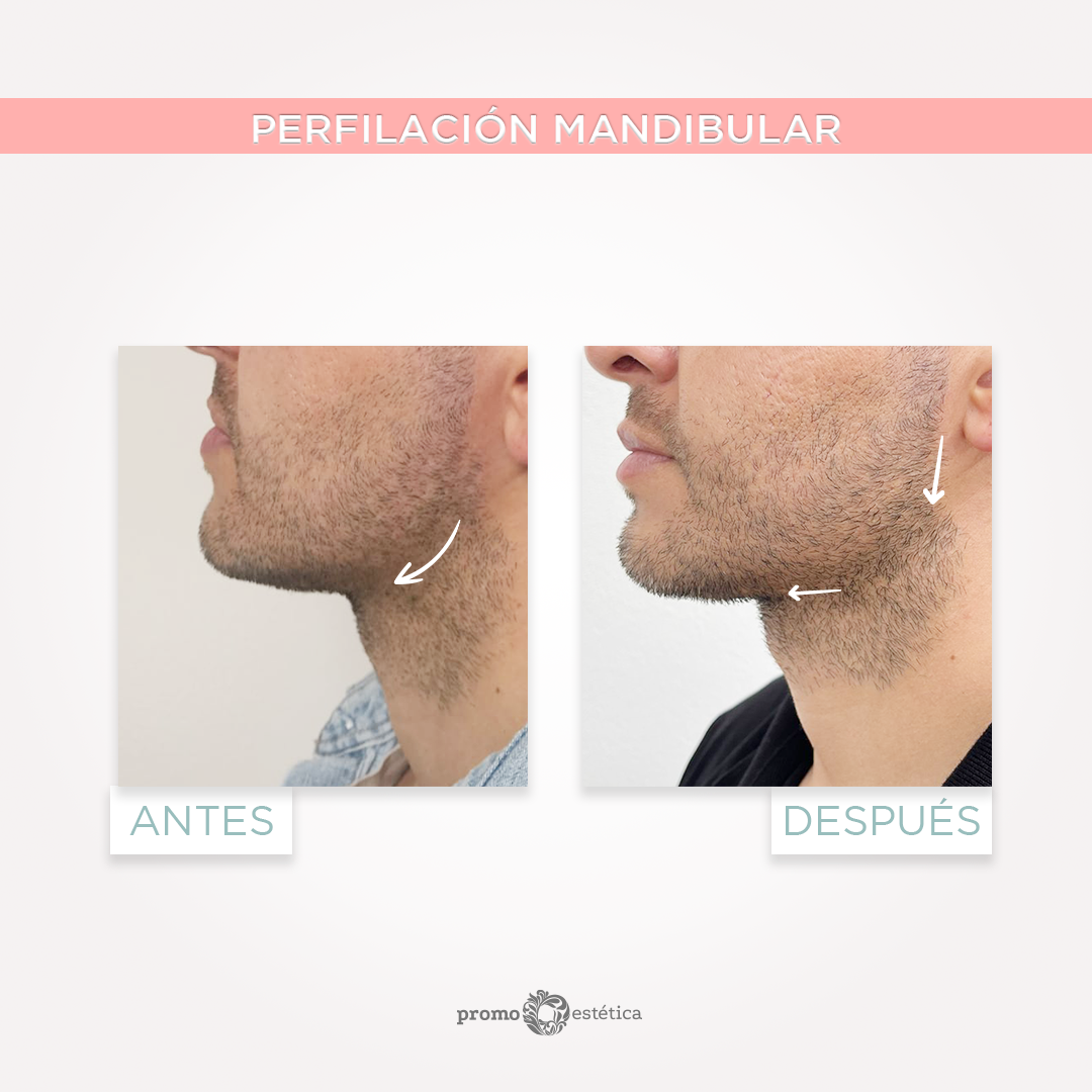 Perfilamiento Facial En promoestetica -antes y después 3