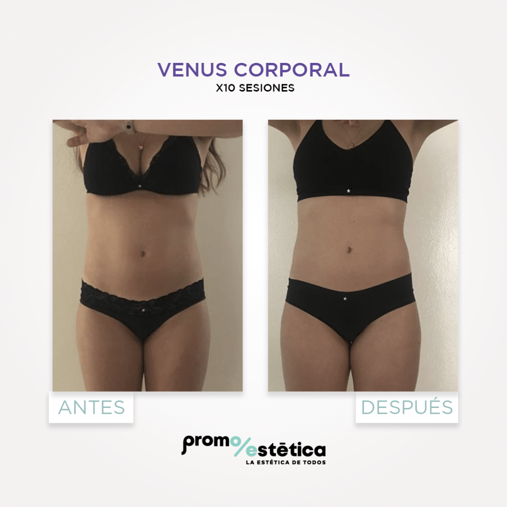 Radiofrecuencia corporal con Venus en Promoestetica resultados 3