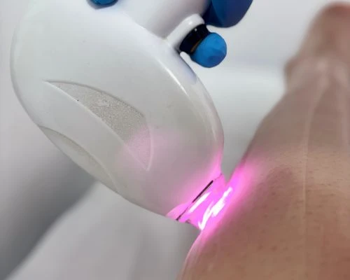 Depilacion-laser-en-promoestetica-aplicación