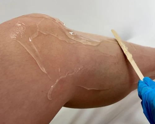 Depilacion-laser-en-promoestetica-aplicación 2