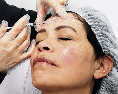 Resultados Full Face y Bioestimulación