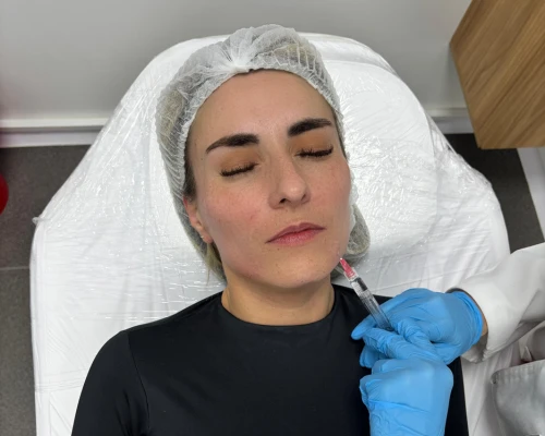 Trataminto estético Profhilo Resultados 1