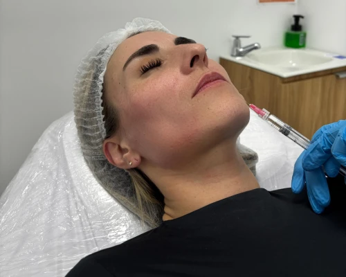 Trataminto estético Profhilo Resultados 2