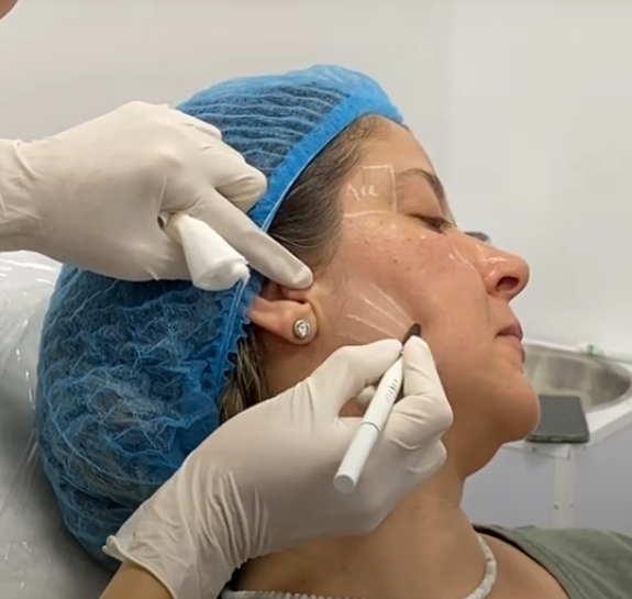 Fotos que muestran el proceso de aplicacion de Acido Poli-L-Lactico Olidia