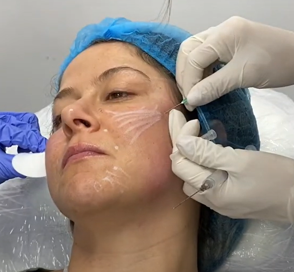 Fotos que muestran el proceso de aplicacion de Acido Poli-L-Lactico Olidia 2