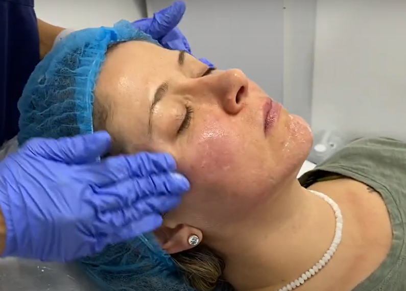 Fotos que muestran el proceso de aplicacion de Acido Poli-L-Lactico Olidia 3