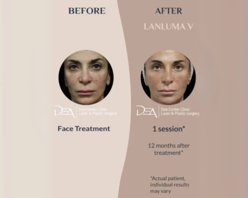 Lanluma En Promoestetica - Antes y después 1