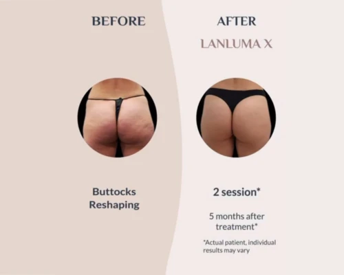 Lanluma en Promoestetica - Antes y después 2