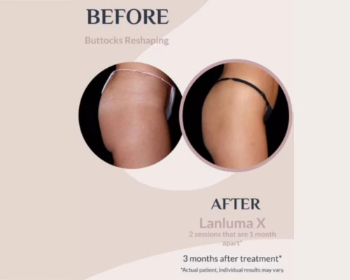 Lanluma en Promoestetica - Antes y después 3