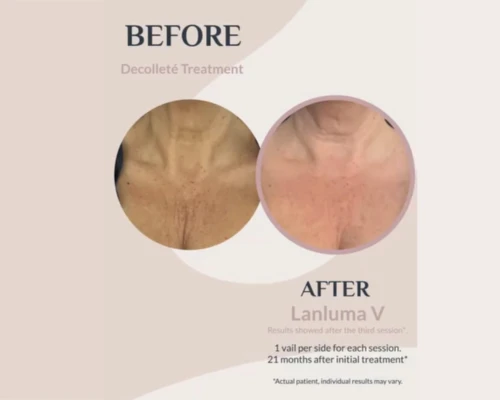 Lanluma en Promoestetica - Antes y después 4