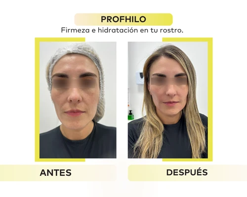 PROFHILO ANTES Y DESPUÉS