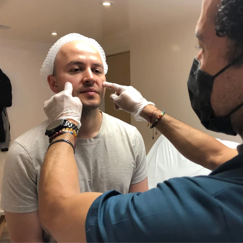 Acido hialuronico en nasoyugal procedimiento