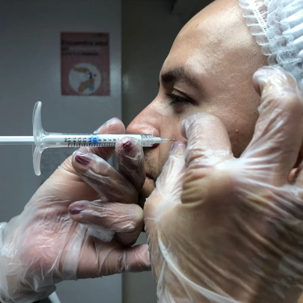 Acido hialuronico nasoyugal procedimiento 2