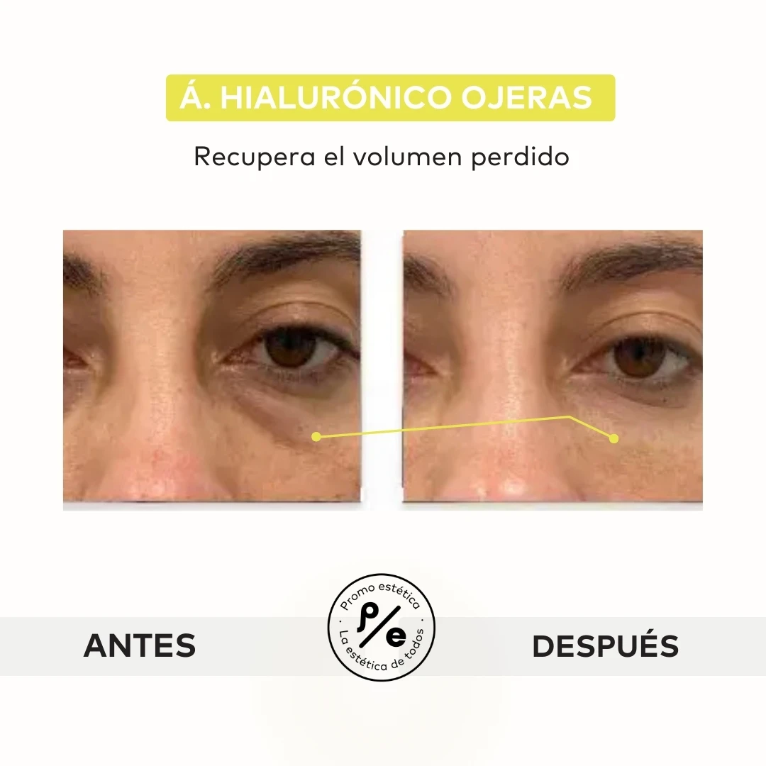 Fotos de antes y después de los procedimientos realizados en Promoestetica 3