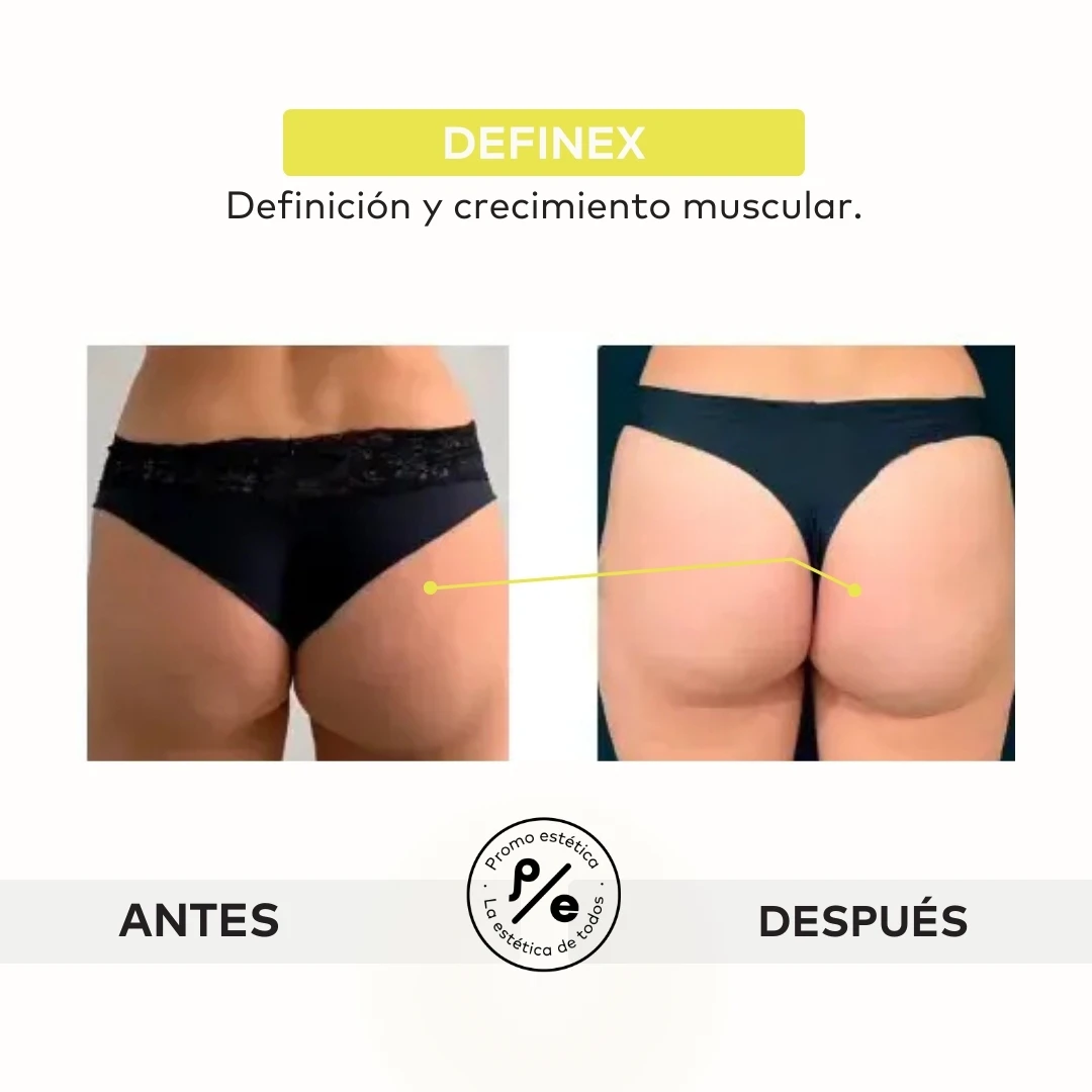 Fotos de antes y después de los procedimientos realizados en Promoestetica 2