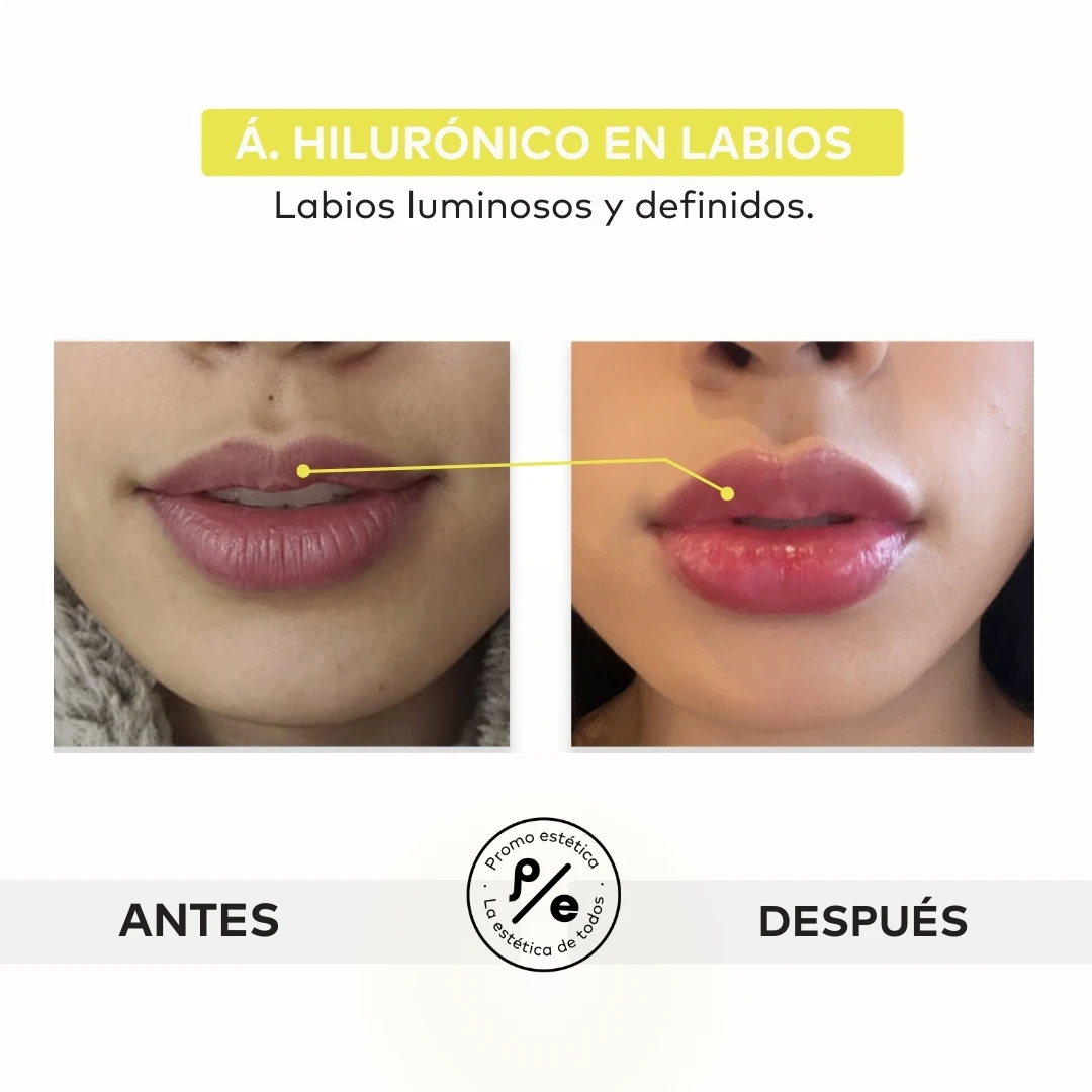 Fotos de antes y después de los procedimientos realizados en Promoestetica