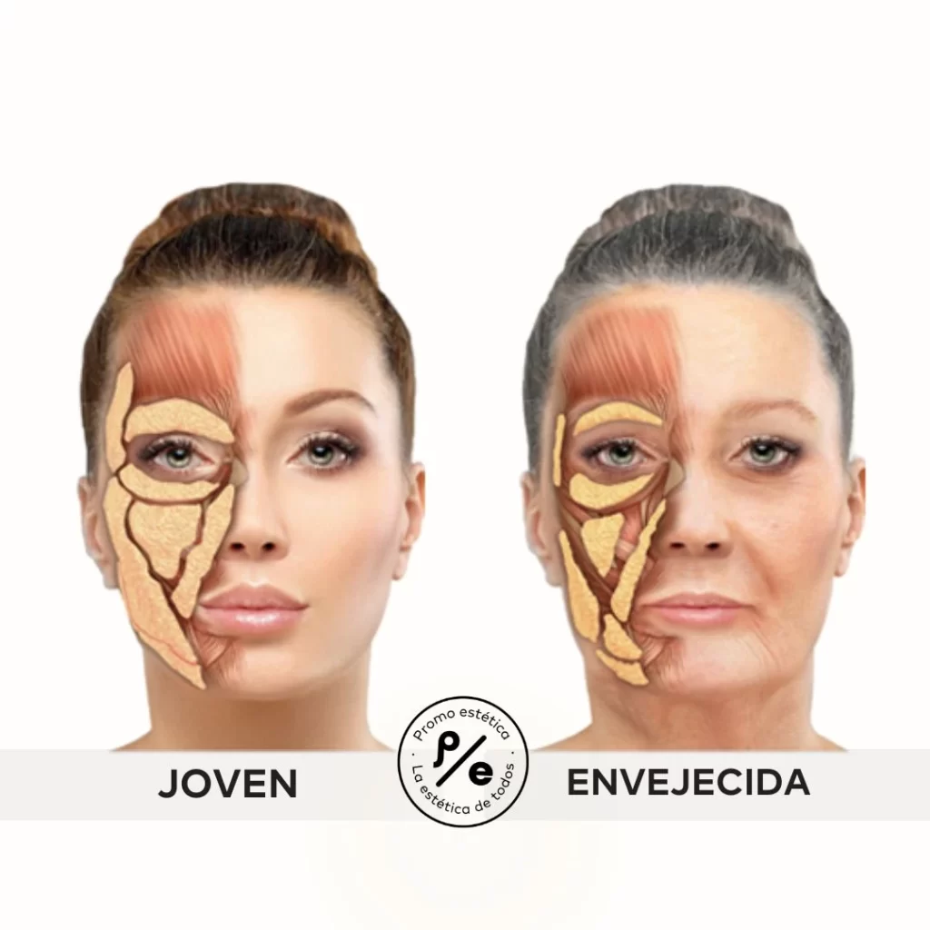 Profhilo Structura - Explicación en Promoestetica