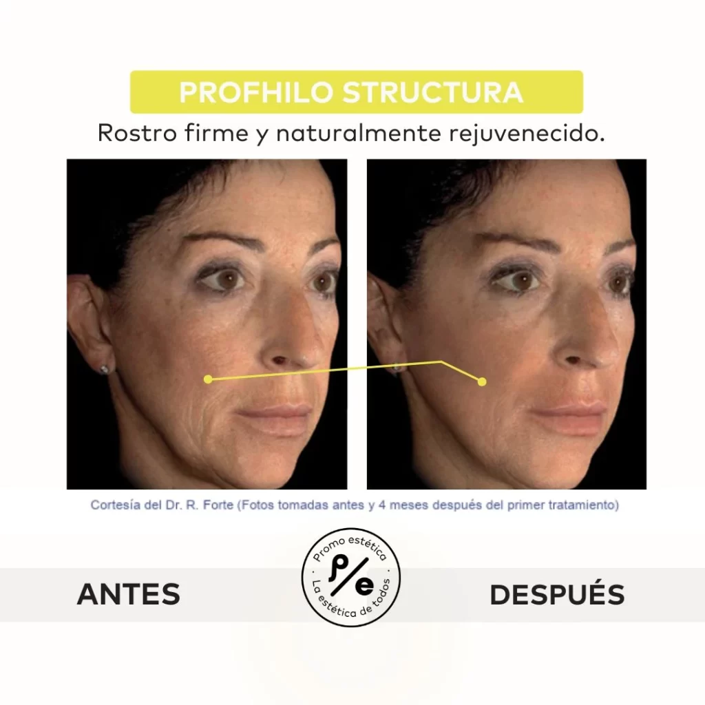 Profhilo Structura - Resultados 1 en Promoestetica