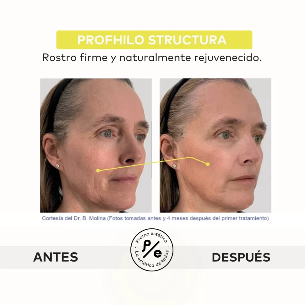 Profhilo Structura - Resultados 2 en Promoestetica
