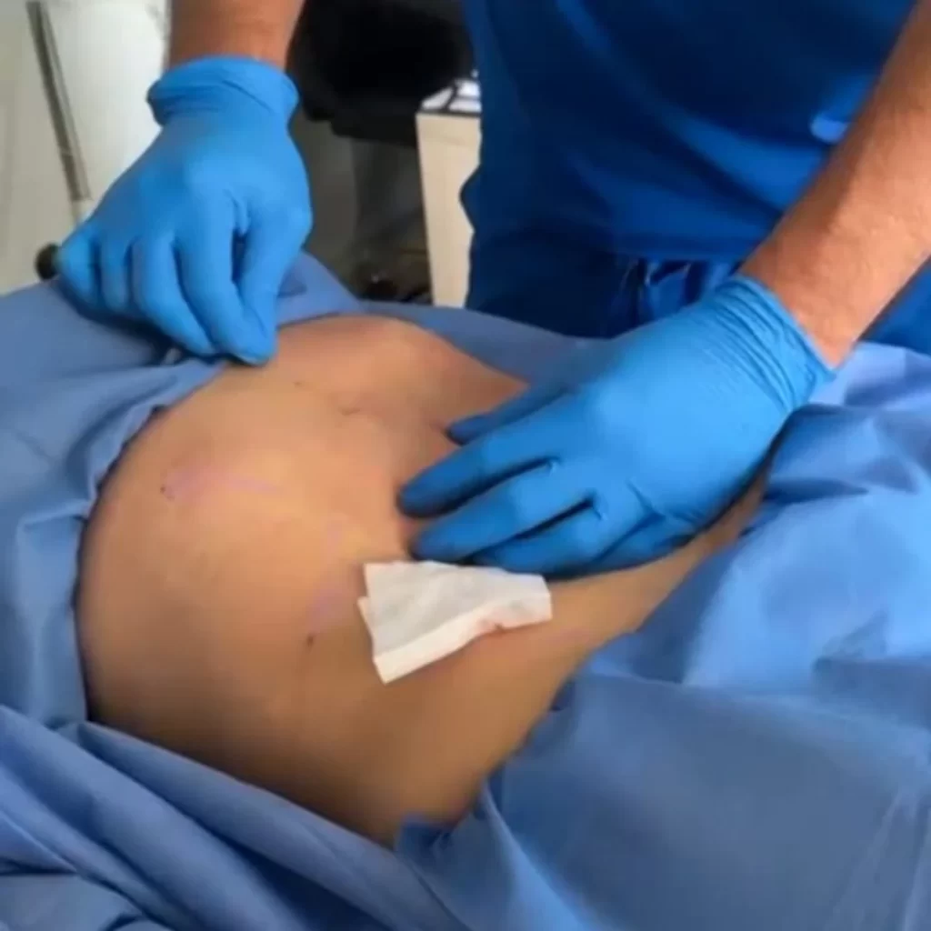 Procedimiento endolifting abdomen en Promoestetica