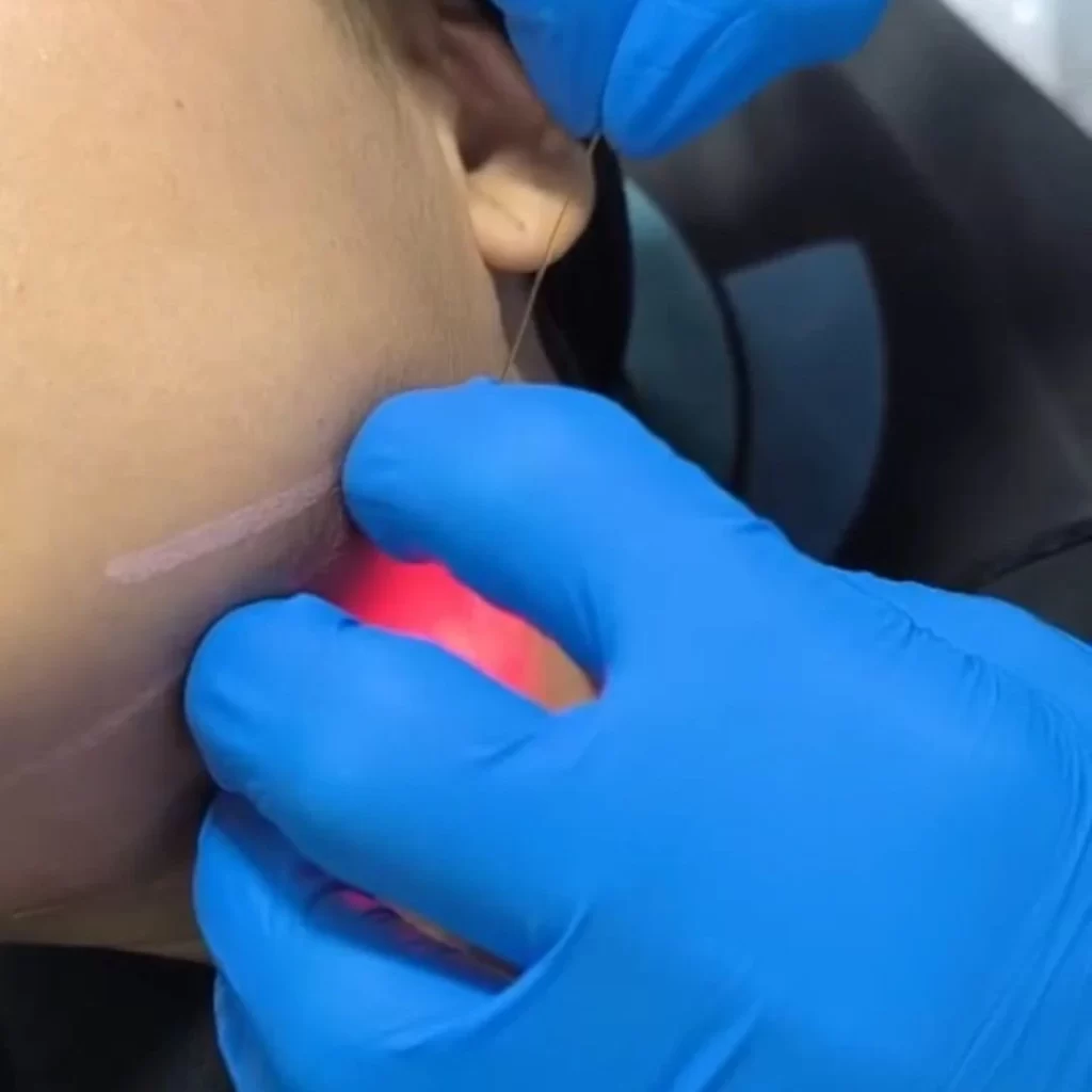 Procedimiento endolifting papada en Promoestetica