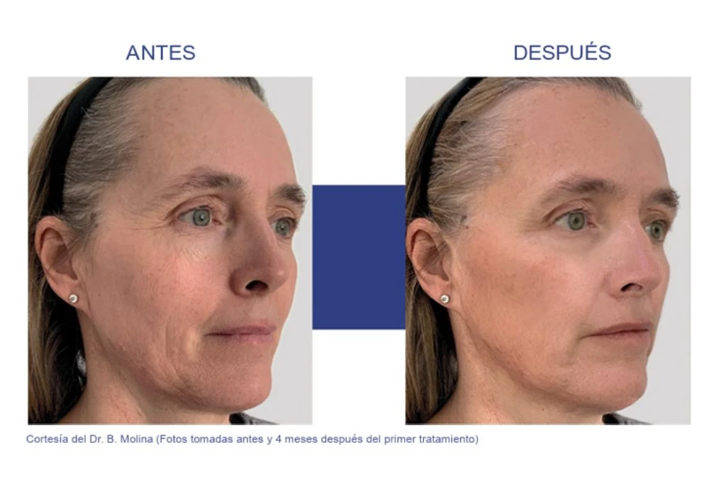 Antes y después de Profhilo Structura