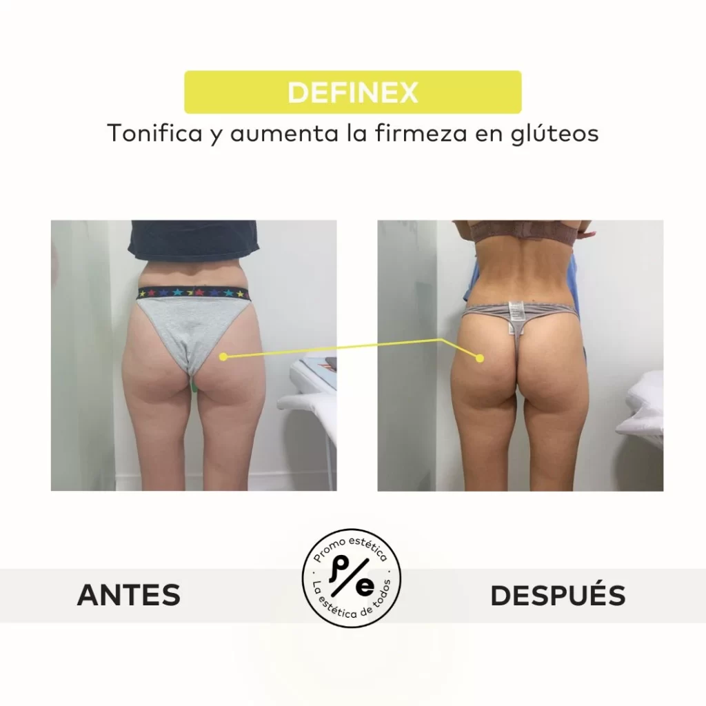 Antes y después del tratamiento Definex en Promoestetica