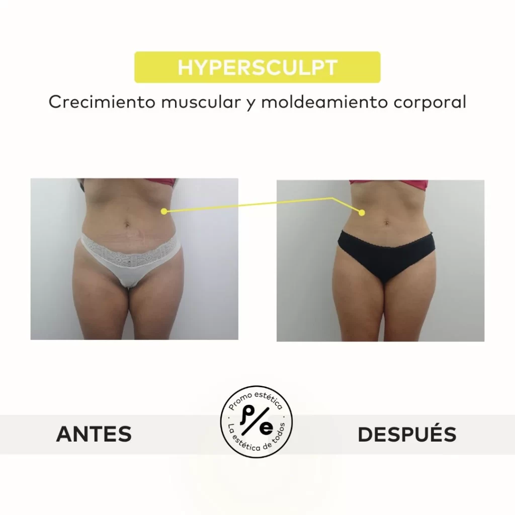 Antes y después del tratamiento Hypersculpt en Promoestetica
